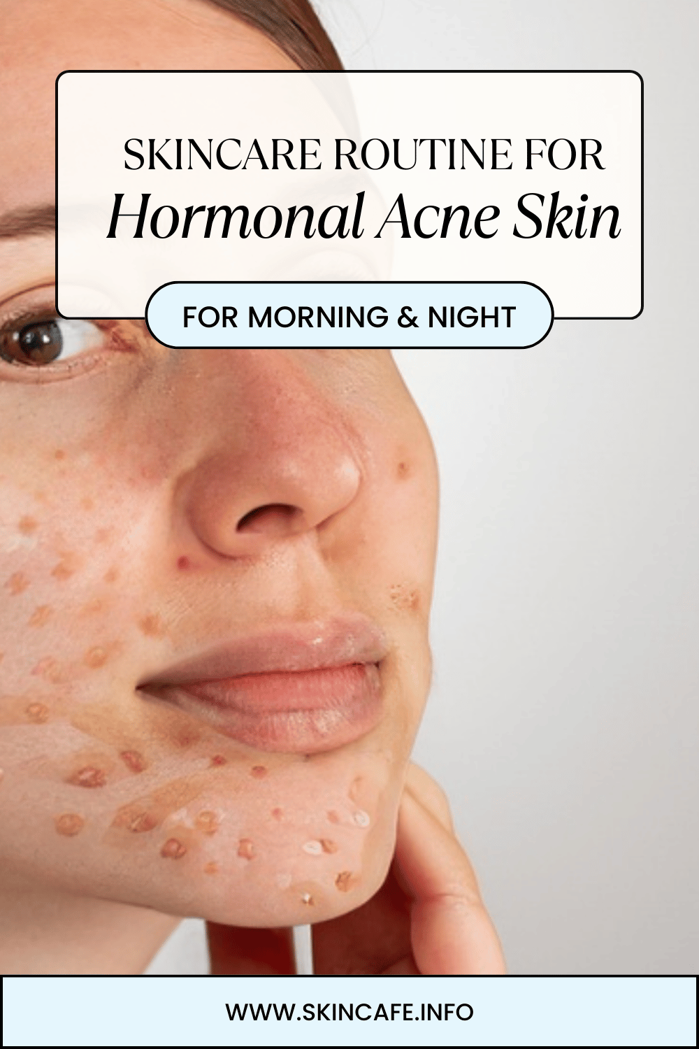 Hormonal Acne Skin